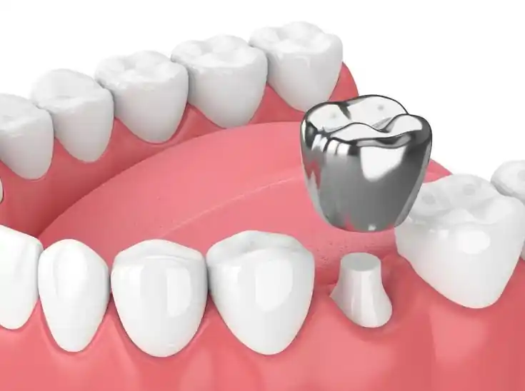 Pediatric Crowns