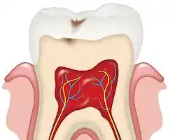 Pulpotomy / Pulpectomy