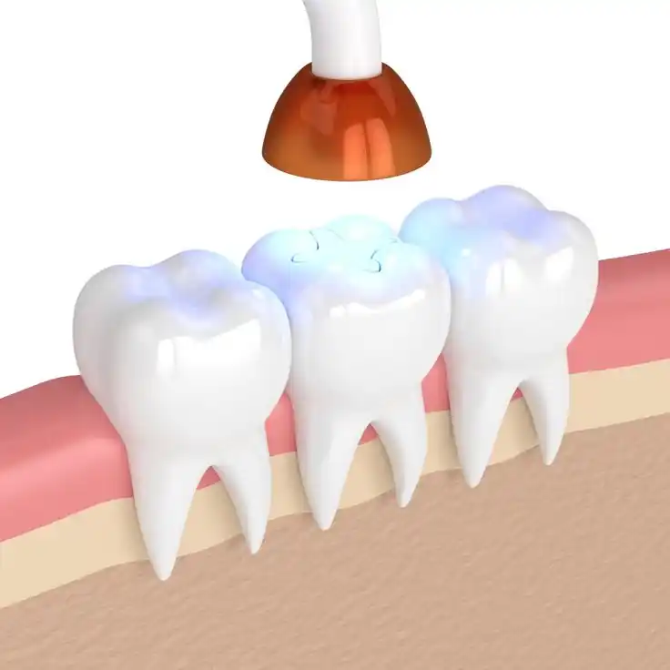 Tooth-Coloured Fillings