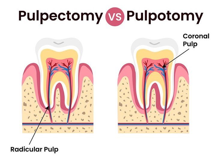 Child after successful baby root canal treatment