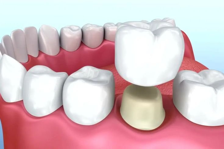 Pediatric dental crown after pulpotomy treatment