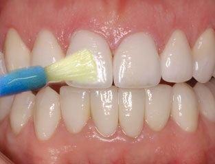 Professional fluoride varnish application for children
