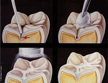 Dental sealant application on children's molars