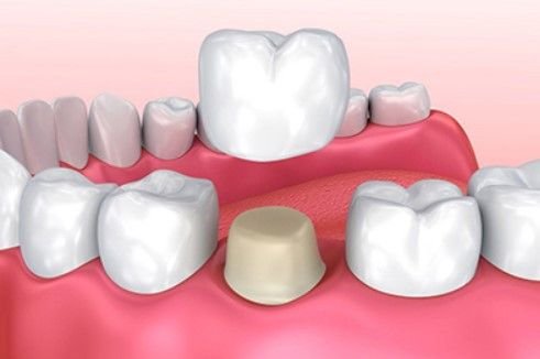 Pediatric dental crowns for children in Vellore