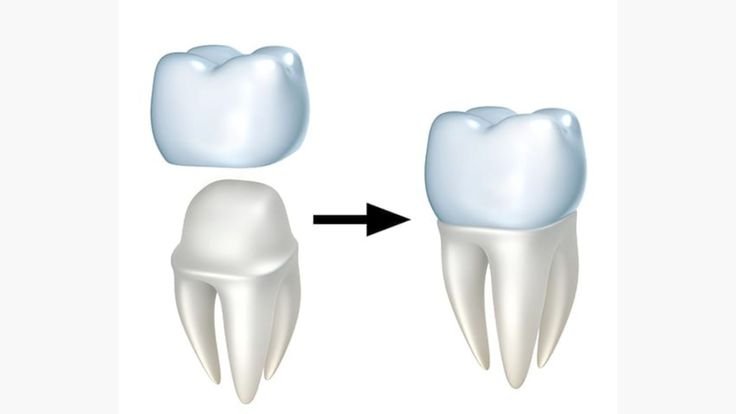 Pediatric dentist placing dental crown on baby tooth