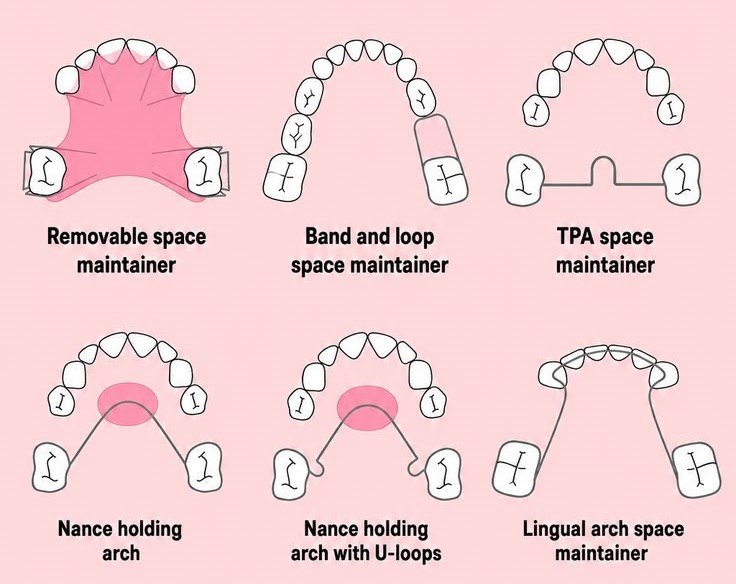 Benefits of space maintainer after early tooth loss
